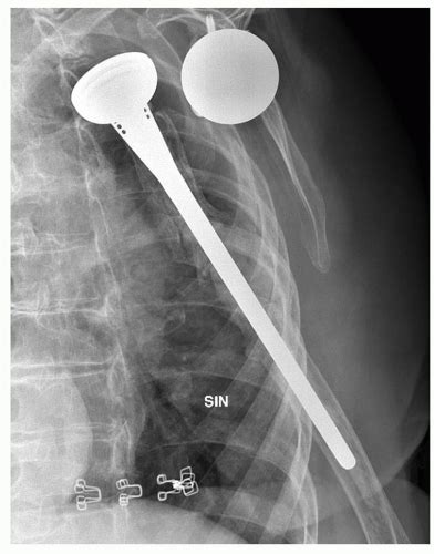 Complications of Reverse Total Shoulder Arthroplasty | Musculoskeletal Key