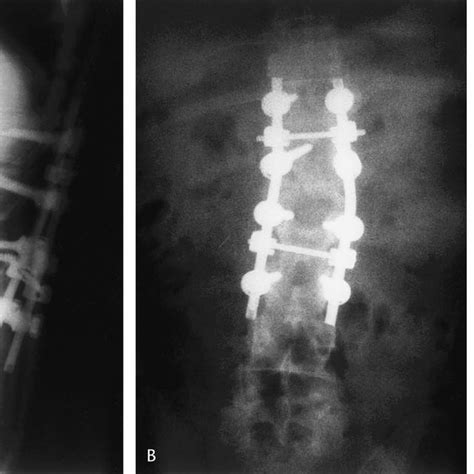 (PDF) Total L1 Vertebrectomy With T12-to-L2 Fusion in a Case of Burst ...