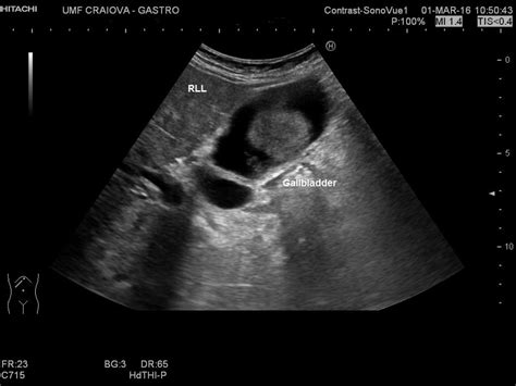 Sludge in gallbladder [1 image] – EFSUMB