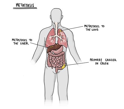 Metastasis - Pathology dictionary - MyPathologyReport.ca