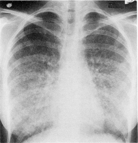 Figure 1 from Pulmonary renal syndromes--a review. | Semantic Scholar