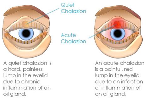 Meibomian Cyst (Chalazion) | Harley Street | Clinica London