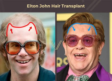 Celebrities With Hair Transplants | 40 Before & After Photos