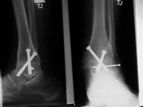 Ankle Arthrodesis : Wheeless' Textbook of Orthopaedics