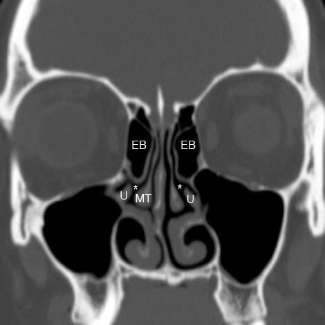 Ethmoid Sinus: Normal Anatomy & Variants