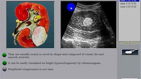 Kidney Tumor Ultrasound