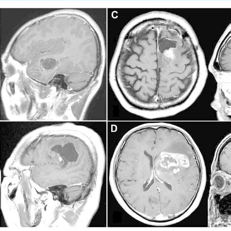 (A) Preoperative contrast-enhanced, T1-weighted magnetic resonance ...