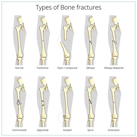 Fractures (Broken Bone) | Fremont Orthopedic & Rehabilitation Medicine