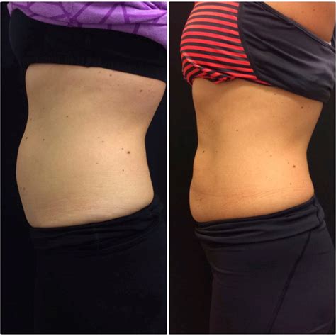 Before and after CoolSculpting®