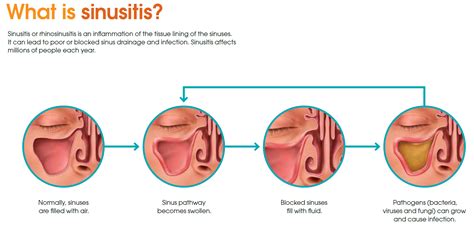 Tired of sinus infections?: Nilesh Patel, MD: Ear, Nose & Throat Doctors