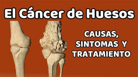 Tipos de cancer de huesos