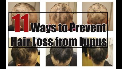 Prevent Hair Loss | 11 Ways to Prevent Hair Loss from Lupus - YouTube