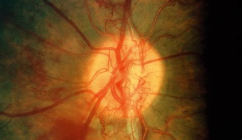 Discoveries in Medicine - Imaging Hypoxia-induced Retinal ...