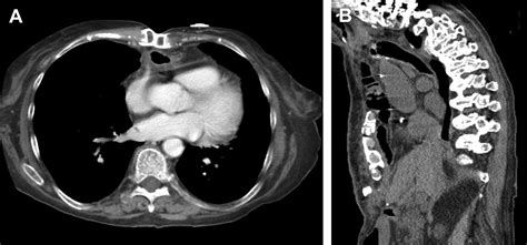 Colon Interposition for Esophageal Cancer - Thoracic Surgery Clinics