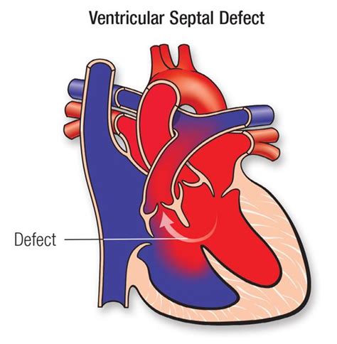 Ventricular Septal Defect (VSD) - Seattle Children's