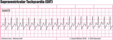 ECG Educator Blog : Supraventricular Tachycardia (SVT)