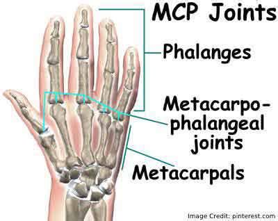 Metacarpophalangeal Joint Pain - Things You Should Know