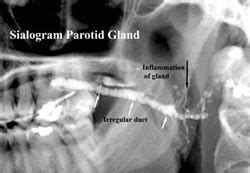 Sialogram - Imaging Glossary - Patients - UR Medicine Imaging Sciences ...