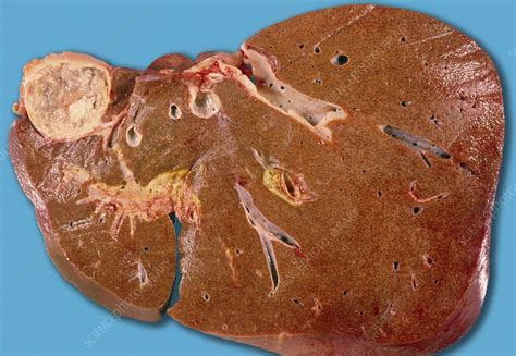 Hydatid cyst of liver - Stock Image M170/0410 - Science Photo Library