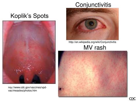 PPT - Measles: Case Study PowerPoint Presentation - ID:6725011