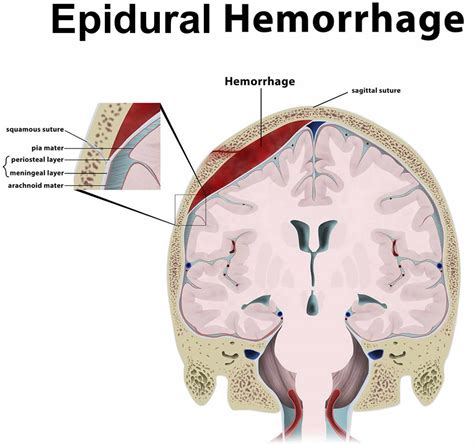 Epidural hematoma causes, signs, symptoms, diagnosis & treatment