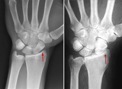 Arthritis of the Wrist - Orthopedic & Sports Medicine