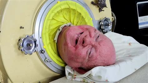 Paul Alexander, polio survivor who spent over 70 years in iron lung ...