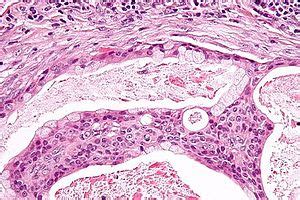 Mucoepidermoid carcinoma - Libre Pathology