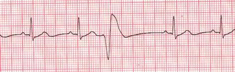 Premature Ventricular Contractions Pvcs With Echo Beats Ecg | Images ...