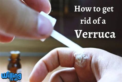 How to Get Rid of a Verruca Rapidly by 3 Tremendous Ways