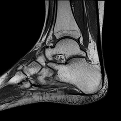 Mri Plantar Foot Anatomy Muscles