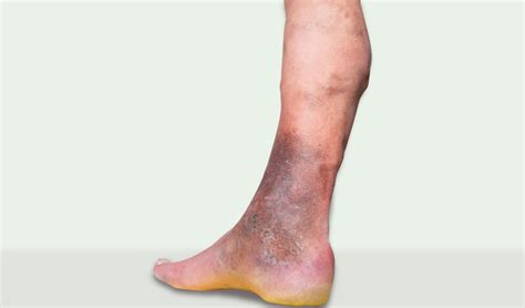 Ankle Discoloration Causes and Treatment | Vein Institute Of Pinellas