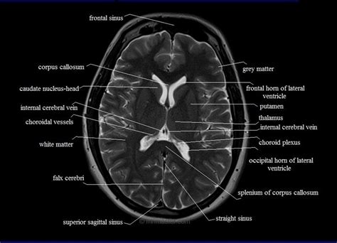 MRI anatomy brain axial image 16 | Brain anatomy, Mri brain, Radiology