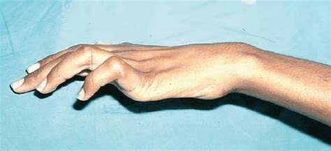 Ulnar Nerve Hand Deformity