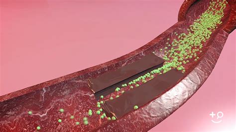 Diabetes - What Is Diabetic Heart Disease? - Doctorpedia