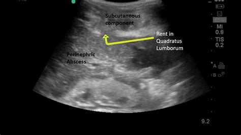 ED Point-of-Care US Case: Perinephric Abscess - YouTube