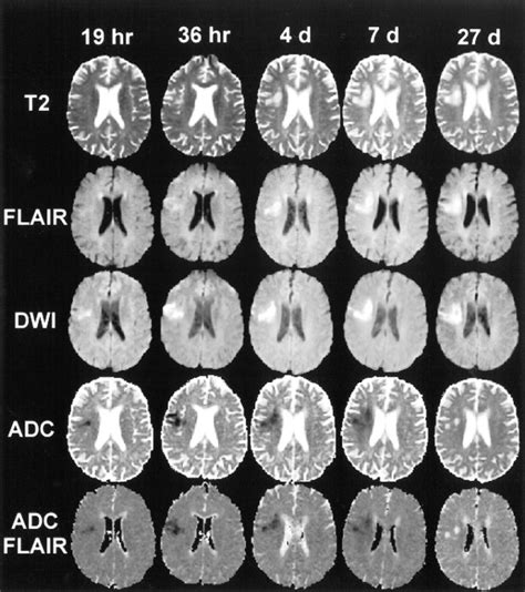 mental change - 강한 자극 통증에만 반응하는 환자 / GCS infarct hemorrhage brain CT ...