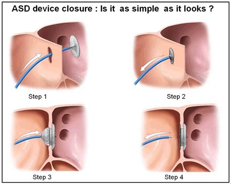 asd closure device www.drsvenkatesan.com | Asd, Cardiology and Atrial ...