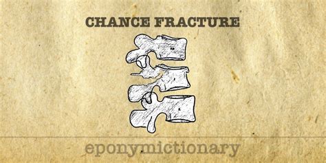 Chance fracture • LITFL Medical Blog • Medical Eponym Library