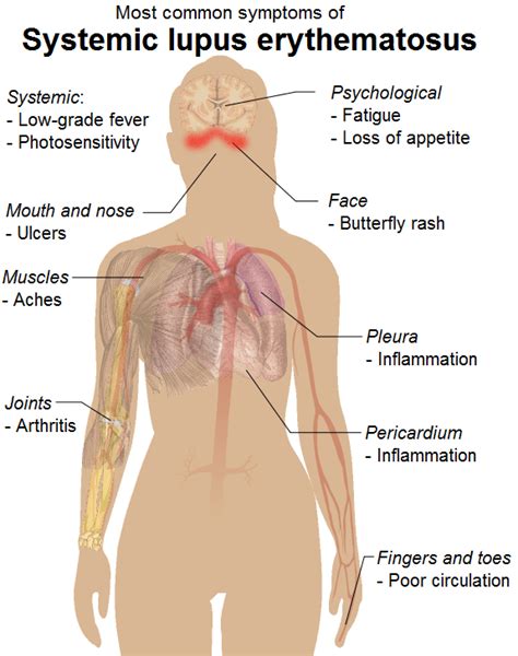 Difference Between Lupus and Fibromyalgia | Compare the Difference ...