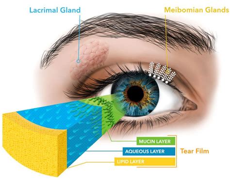 Meibomian Gland Dysfunction Treatment in Nappanee IN