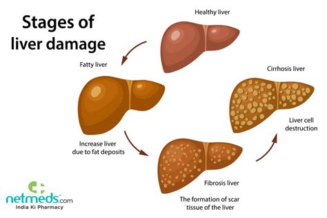 Hepatic Cirrhosis: Causes, Symptoms And Treatment