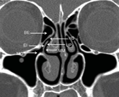 Anatomía normal del complejo osteomeatal tomado de Vaid et al., (10 ...