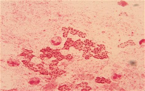 Gram stain for sputum smear from cystic fibrosis patient | Medical ...