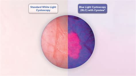 Bladder Cancer Diagnosis | Roswell Park Comprehensive Cancer Center