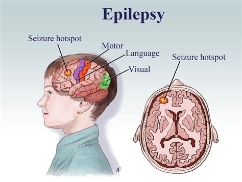 Best Epilepsy Treatment In Gwalior Women With Epilepsy: Lead A Normal ...