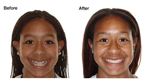 headgear braces before and after - Captions Nature