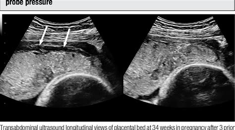 Figure 1 from Placenta accreta spectrum: pathophysiology and evidence ...