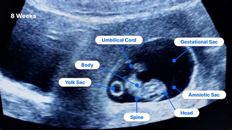 8-Week Ultrasound: Pictures, Fetus Size, Twins and More