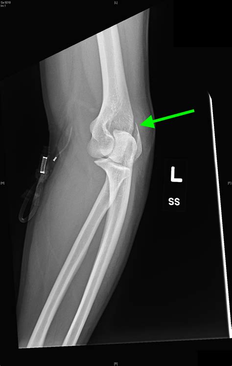 Lateral Epicondyle Fracture, Left Elbow XR, Annotated. JETem 2018 - JETem